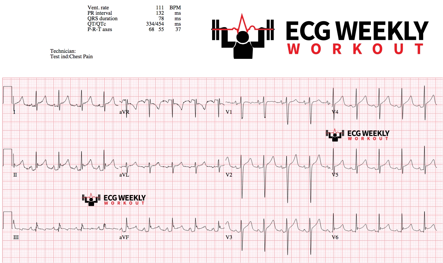 Presenting ECG — Literature Review: STEMI vs. acute pericarditis