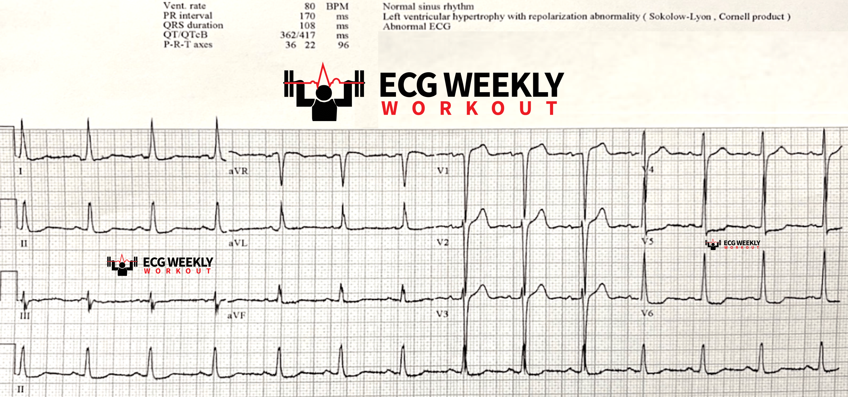 Presenting ECG — STAT ECG Diagnoses: how to identify acute coronary occlusion MI in patients with LVH with strain pattern