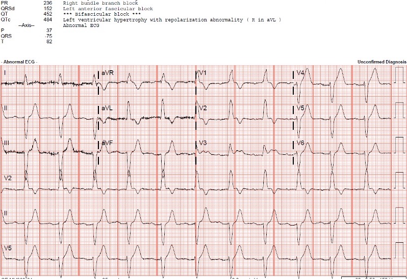 Presenting ECG — STAT ECG Diagnoses: how to identify acute coronary occlusion myocardial infarction in patients with right bundle branch blocks (RBBB)