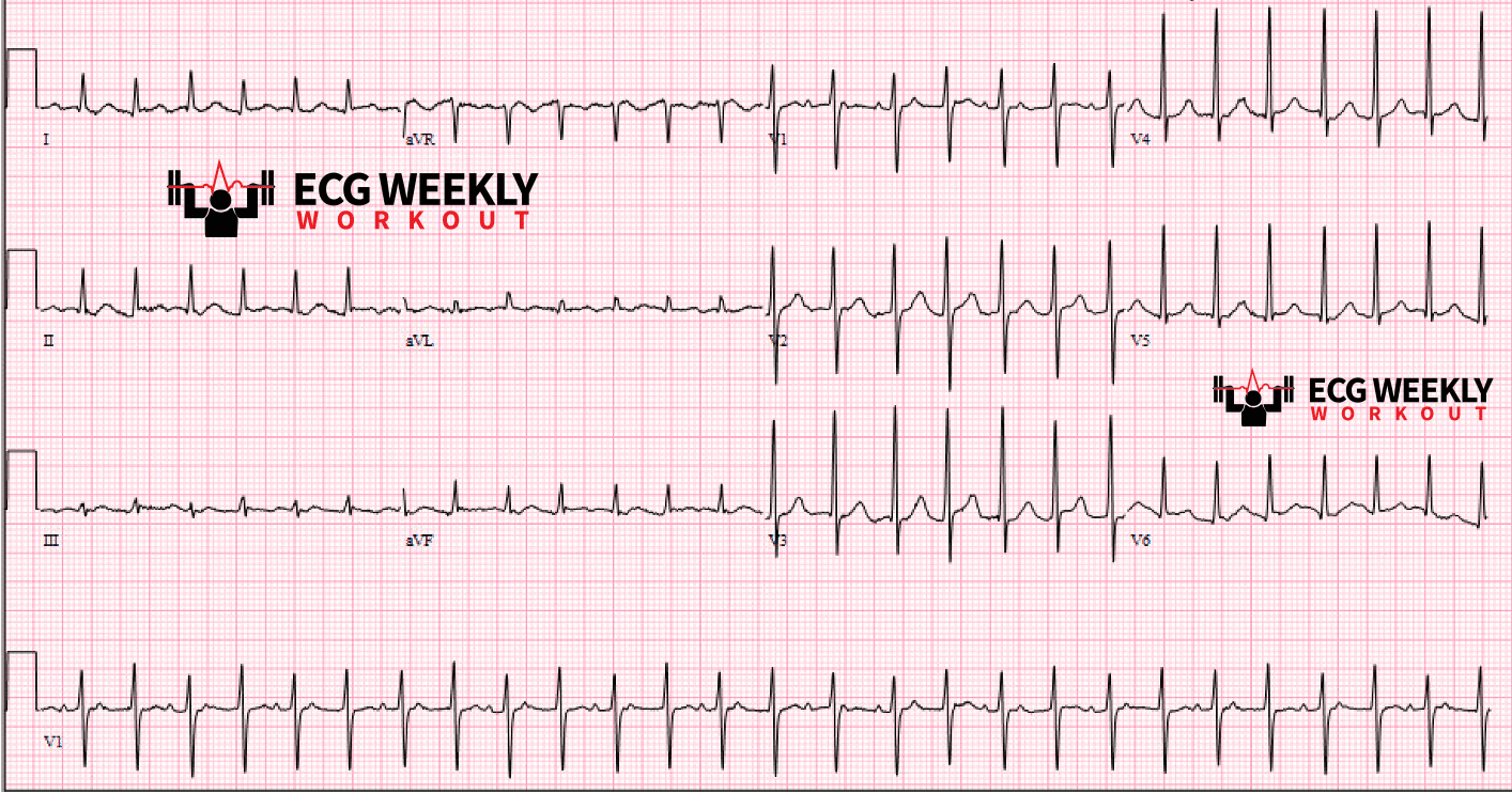 Presenting ECG — UMEM cases that will teach you how to differentiate narrow complex regular and irregular tachycardias, electrocardiographic polyuria (too many P waves) and so much more!