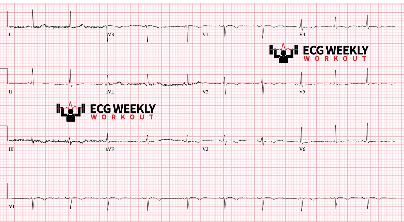 Presenting ECG — Differential Diagnoses: the many causes of T wave inversions in the anteroseptal leads and how to differentiate them