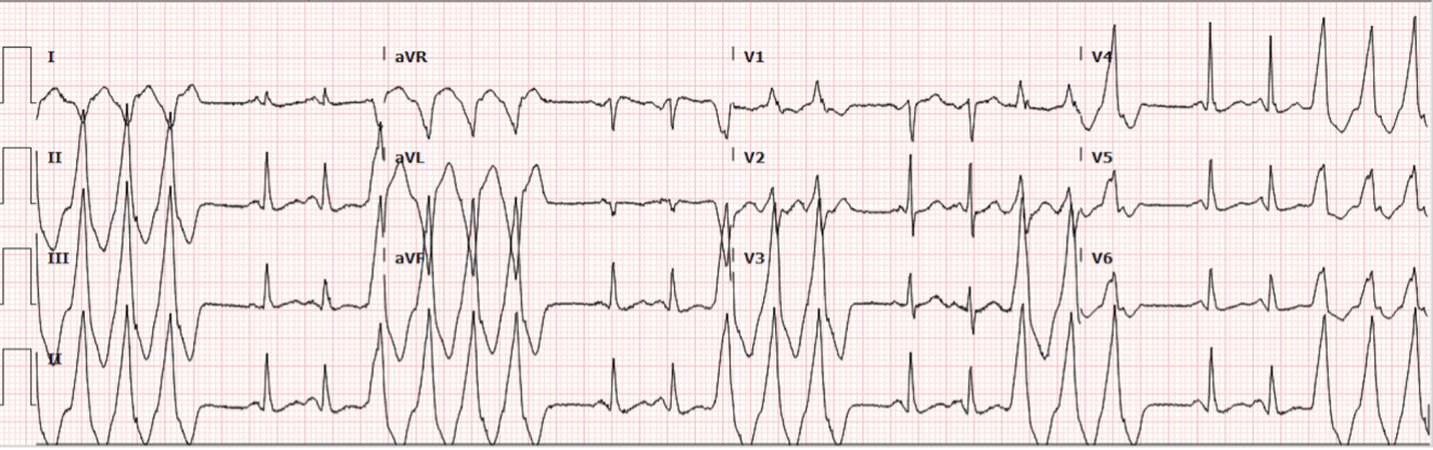 2023 UMEM-ECG-Case-3