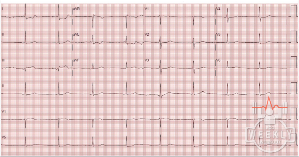 Presenting ECG — ECG Basics & Fundamentals: A stepwise approach to ECG interpretation in patients with chest pain and clinical concern for an acute coronary syndrome (ACS) with pearls and pitfalls in obtaining chest pain histories