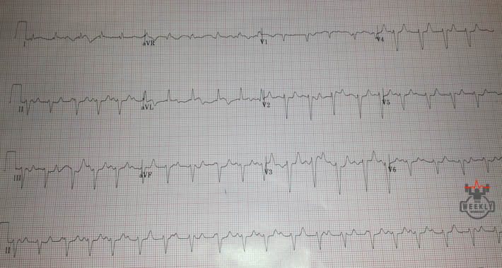 Presenting ECG — Rhythm Interpretation: a three-step approach to diagnosing AV blocks