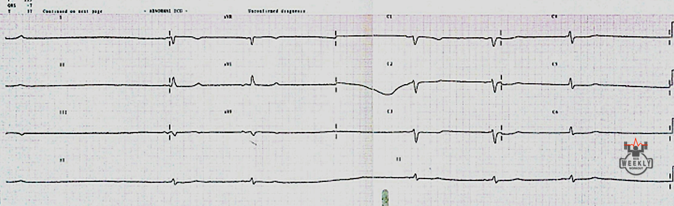 Presenting ECG — Bradyarrhythmias: bizarre slow rhythm that is not responding to ACLS
