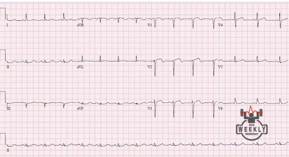 Presenting ECG — STAT ECG Diagnoses: activate the cath lab or get an urgent cardiology consult?