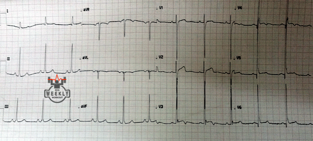 Presenting ECG — STAT ECG Diagnoses: abnormal T waves that suggest badness, and their mimics