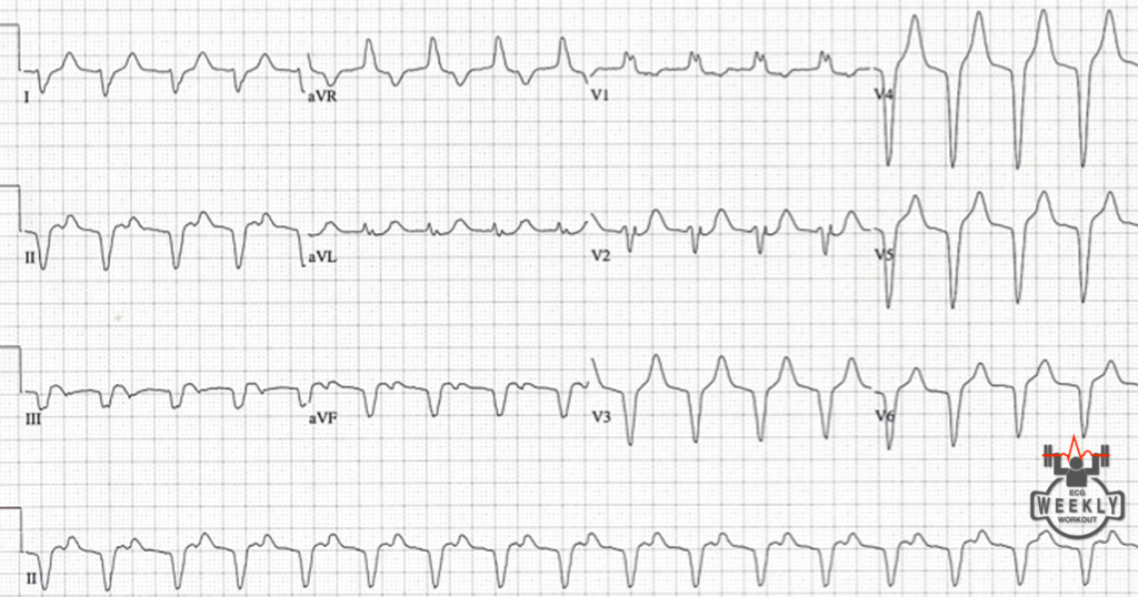 Presenting ECG — STAT ECG Diagnoses: dysrhythmias in patients with STEMI