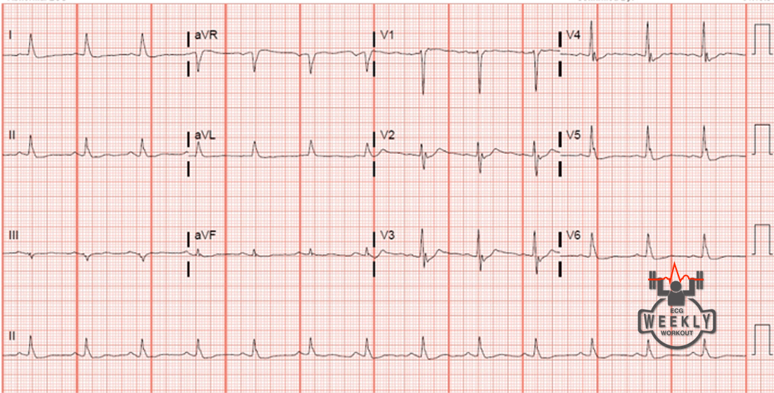 Presenting ECG — STAT ECG Diagnoses: post-cardiac arrest and syncope differentials you can't miss