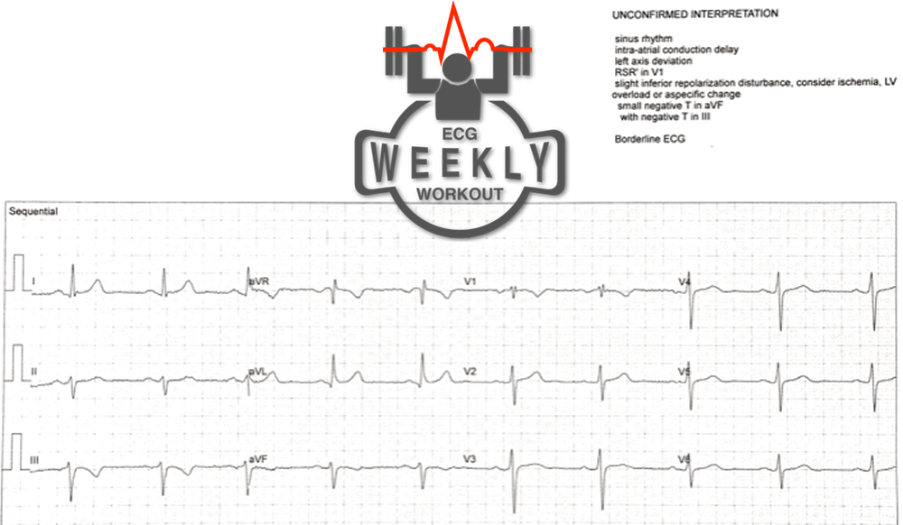 Presenting ECG — ECG Basics & Fundamentals: the ECG must always be interpreted in the context of clinical presentation