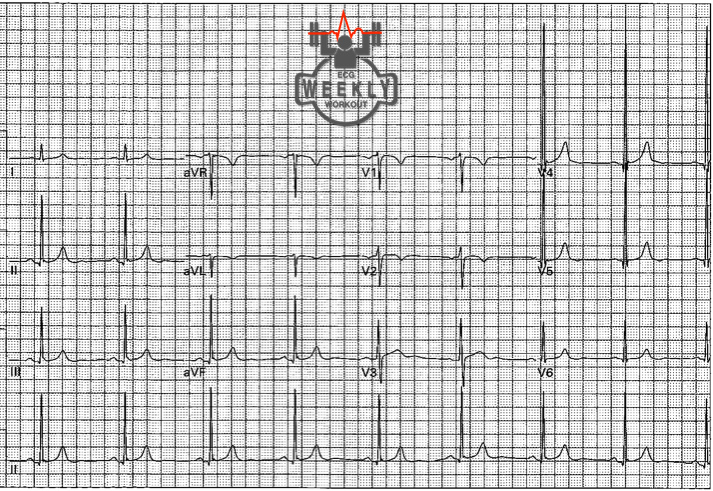 Presenting ECG — STAT ECG Diagnoses: inverted U waves