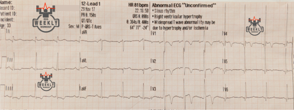 Presenting ECG — STAT ECG Diagnoses: Wellens syndrome and pseudo-Wellens waves