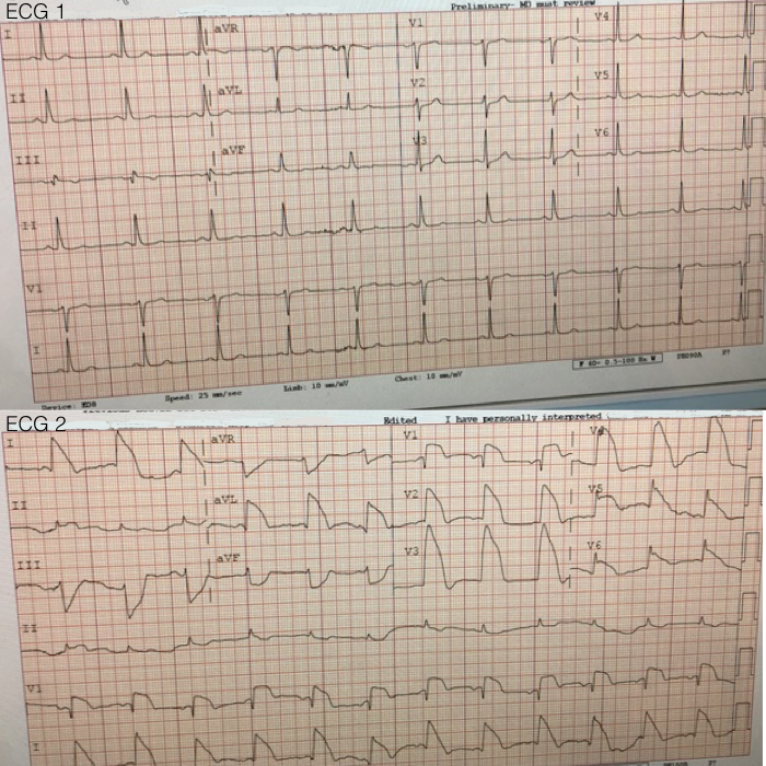 Presenting ECG — STAT ECG Diagnoses: "Shark fin STEMI" morphology and what this ECG pattern means!