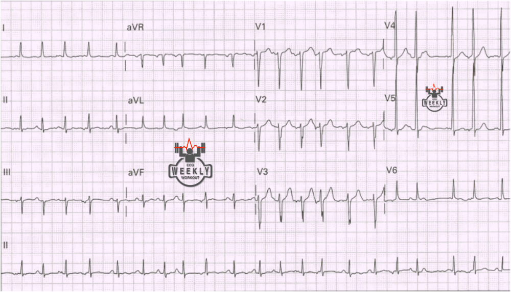 Presenting ECG — Differential Diagnoses: three main causes of narrow complex irregular tachycardias