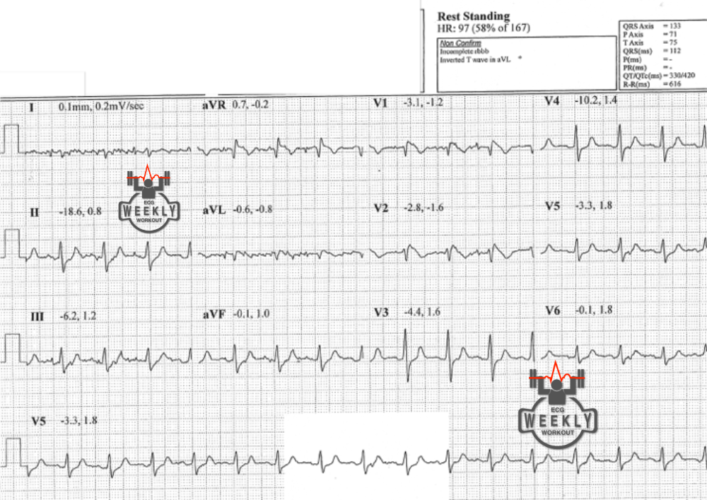 Presenting ECG — ECG reveals a can't miss genetic cause of cardiac syncope