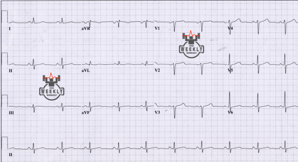Presenting ECG — Risk stratification of acute coronary syndromes (ACS) and differential diagnoses for poor R wave progression