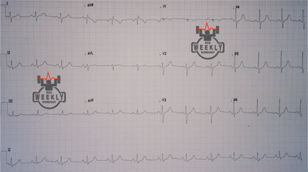 Presenting ECG — ECG Basics & Fundamentals: Crochetage pattern of QRS notching in the inferior leads