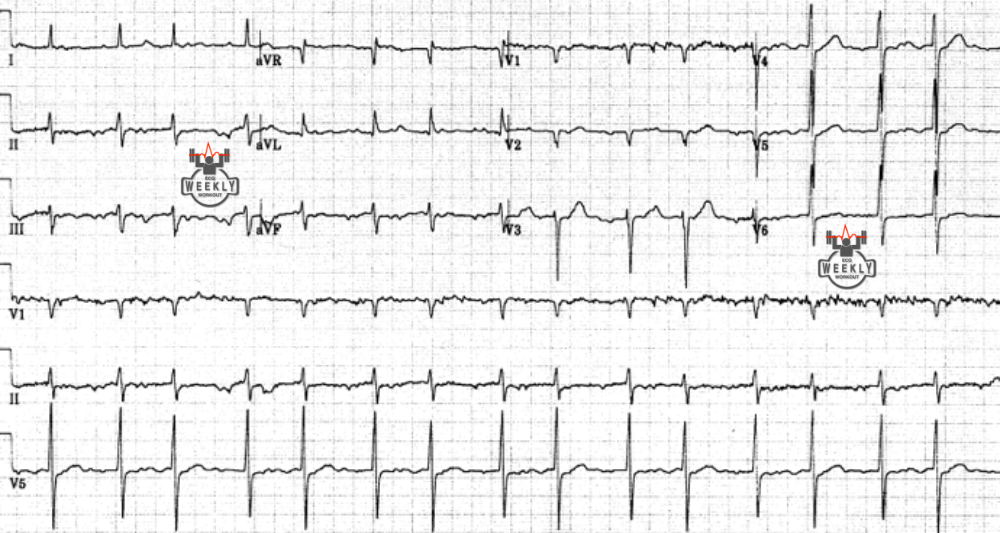 Presenting ECG — How to avoid misdiagnosing the most overcalled tachyarrhythmia by physicians and EGC machines