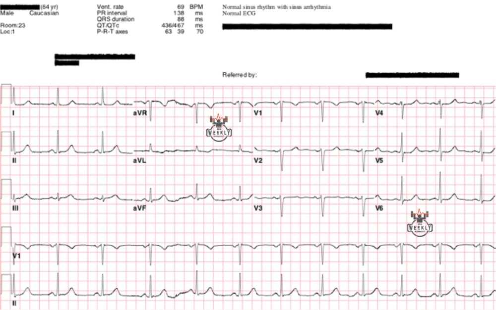 Presenting ECG — Literature Review: limitations of computer interpreted electrocardiograms