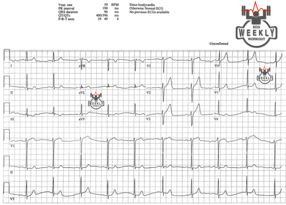 Presenting ECG — Literature Review: classic STEMI criteria, and the cardiovascular effects of Marijuana