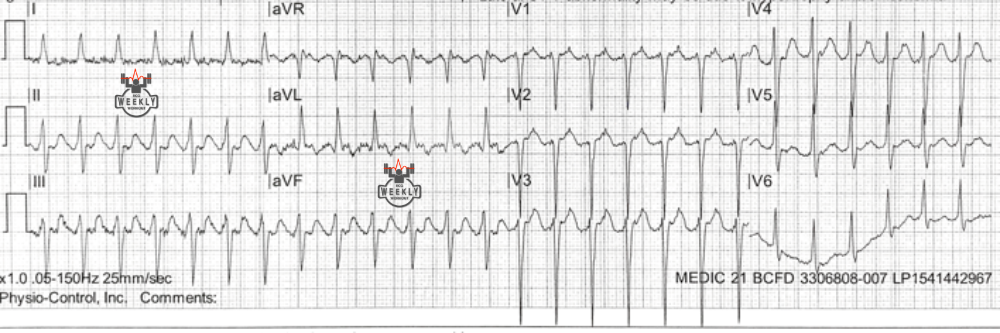 Presenting ECG — The Bix rule in narrow complex tachycardia