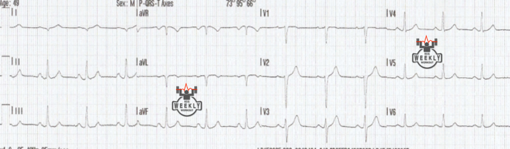 Presenting ECG — How serial ECGs can save lives!