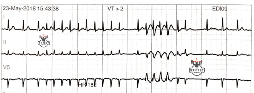 Presenting ECG — Intermittent runs of nonsustained ventricular tachycardia