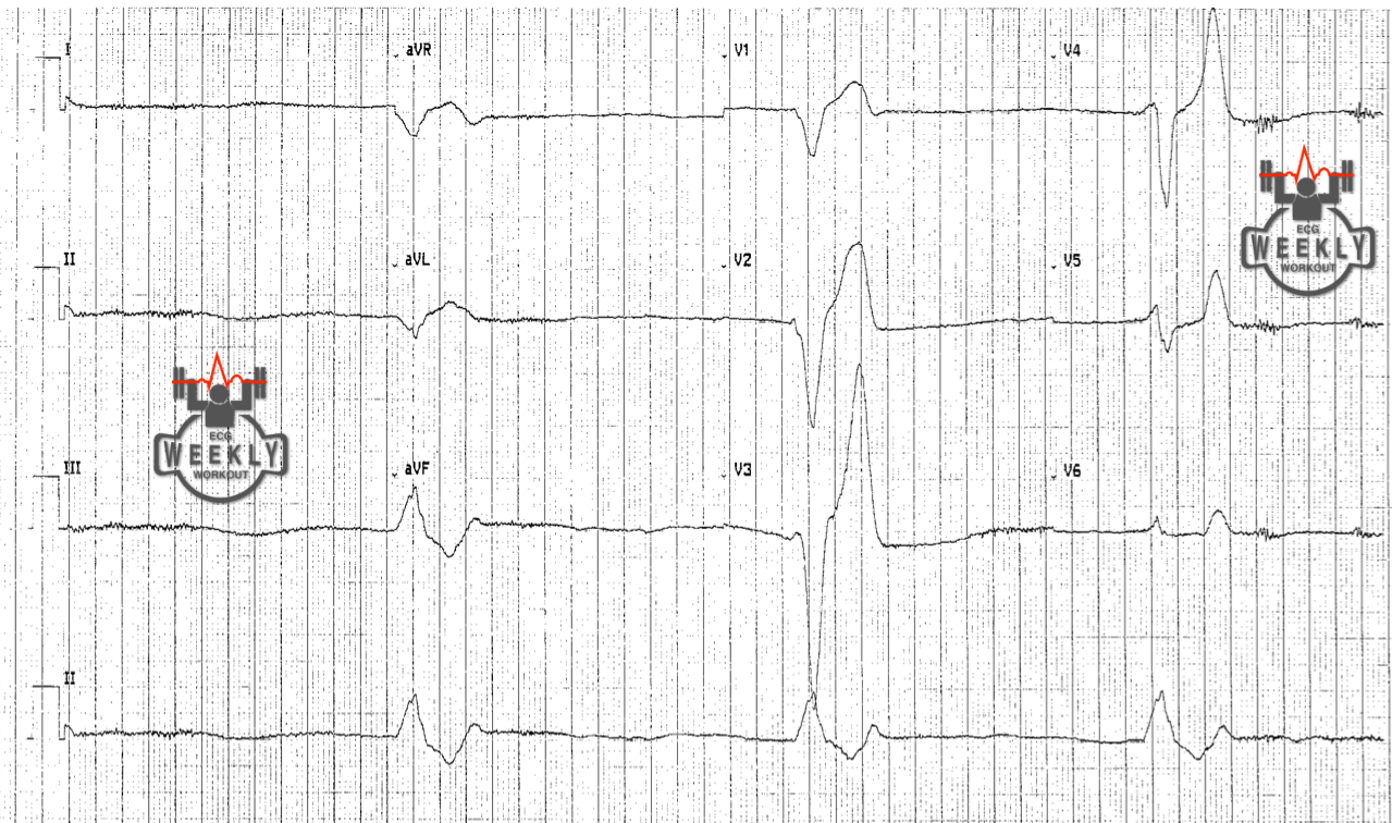 Presenting ECG — STAT ECG Diagnoses: what to do when advanced life support (ACLS) does not work