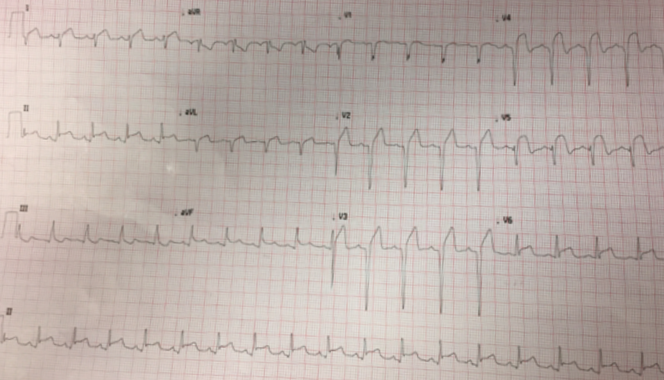 Presenting ECG — Differential Diagnosis: STEMI vs. acute pericarditis