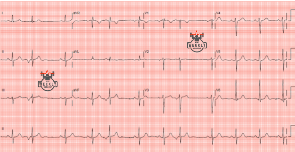 Presenting ECG — ECG Basics and Fundamentals: does negative troponin ACS still exist?