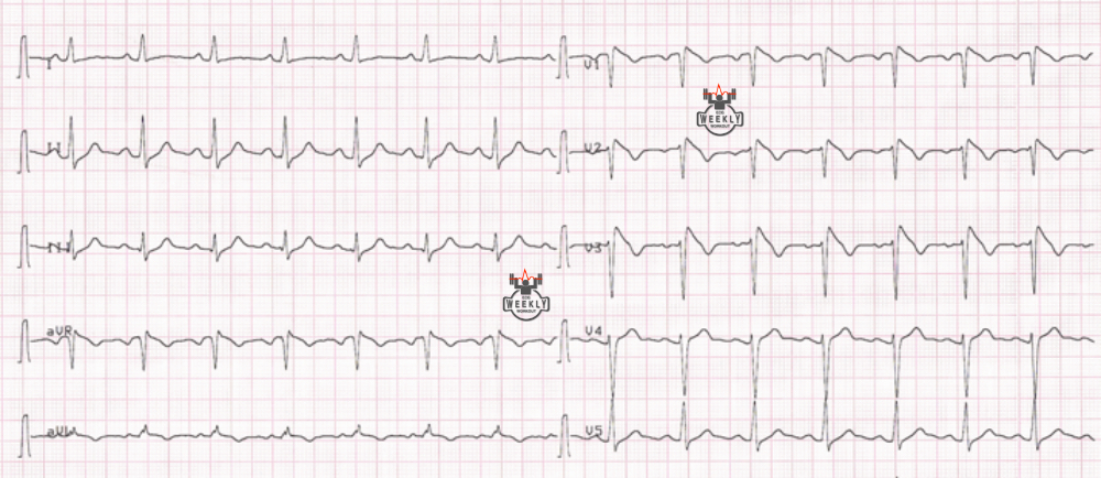 Presenting ECG — Syncope: Brugada Syndrome