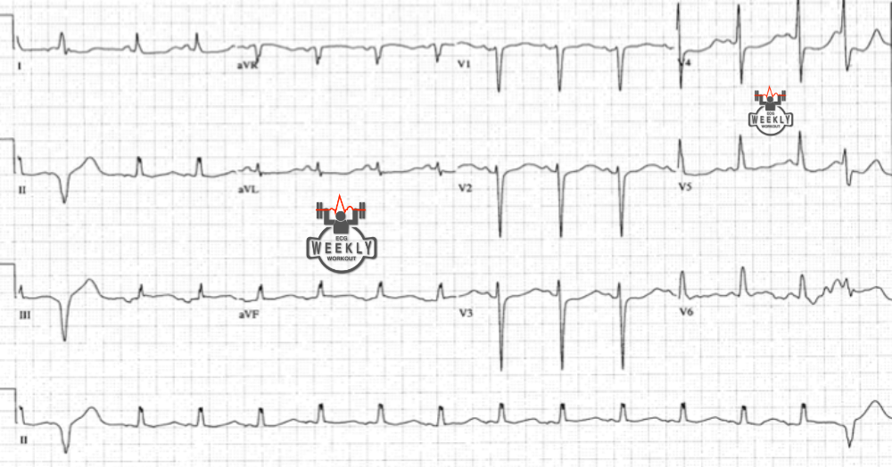 Presenting ECG — Differential Diagnoses: a triad of long QT interval, PVCs, & ST segment depression