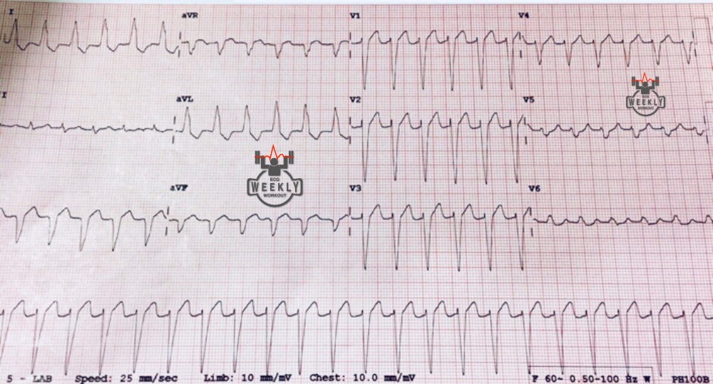 Presenting ECG — Rhythm Interpretation: using lewis leads to nail the diagnosis