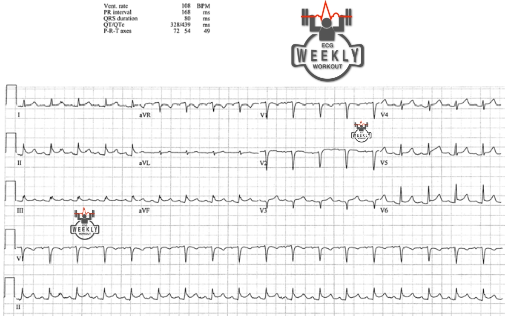 Presenting ECG — ECG Basics & Fundamentals: the sensitive vs. specific definitions for low voltage QRS complexes and differentials that cause them