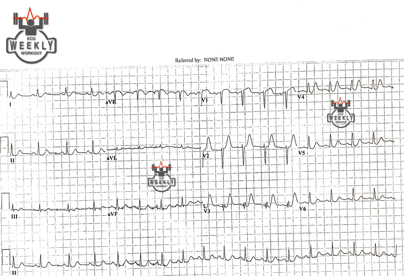 Presenting ECG — ECG Basics & Fundamentals: respect the T waves!