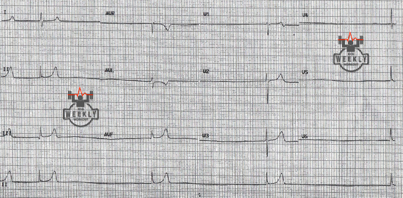 Presenting ECG — Bradydysrrhytmias: altered mental status, hypotension, and not able to transcutaneously pace