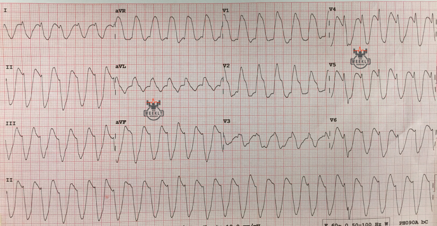 Presenting ECG — STAT ECG Diagnoses: REALLY wide complex tachycardia