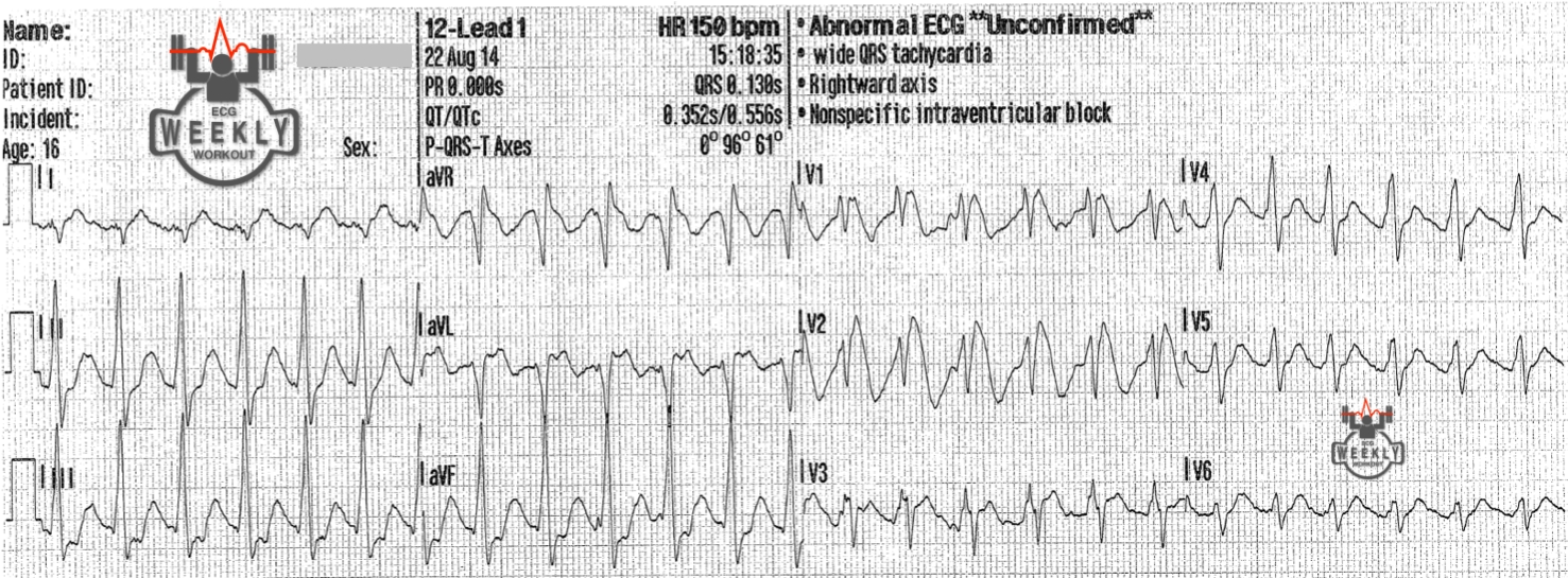 Presenting ECG — STAT ECG Diagnoses: the ECG findings in sodium channel blocker toxicity