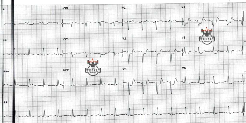 Presenting ECG — STAT ECG Diagnoses: criteria for right ventricular myocardial infarction (RVMI)