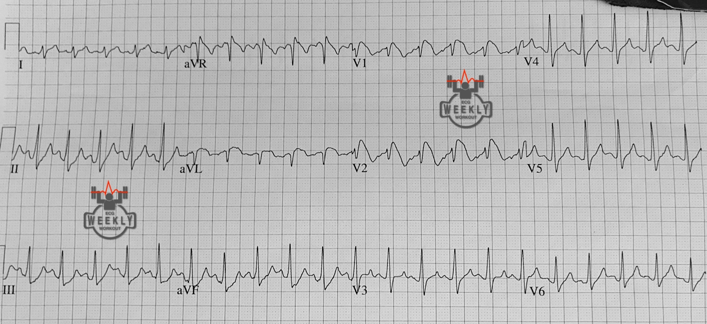 Presenting ECG — STAT ECG Diagnoses: the most rapid killer in diabetic ketoacidosis (DKA)