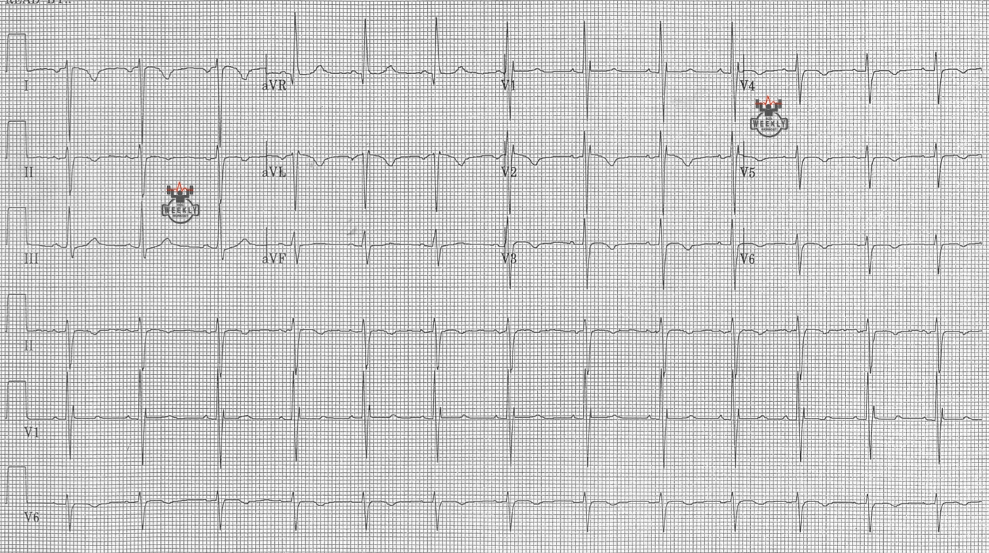 Presenting ECG — ECG Basics & Fundamentals: ECG findings of dextrocardia