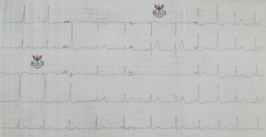 Presenting ECG — Wolff-Parkinson-White: a ventricular preexcitation syndrome