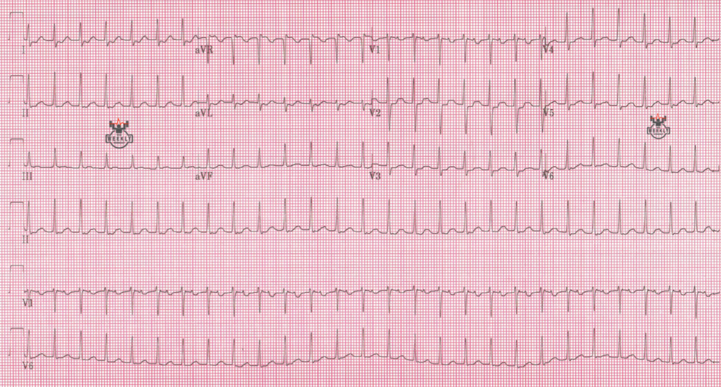 Presenting ECG — Narrow Complex Tachycardias: the importance of careful ECG interpretation after cardioversion for tachyarrhythmia
