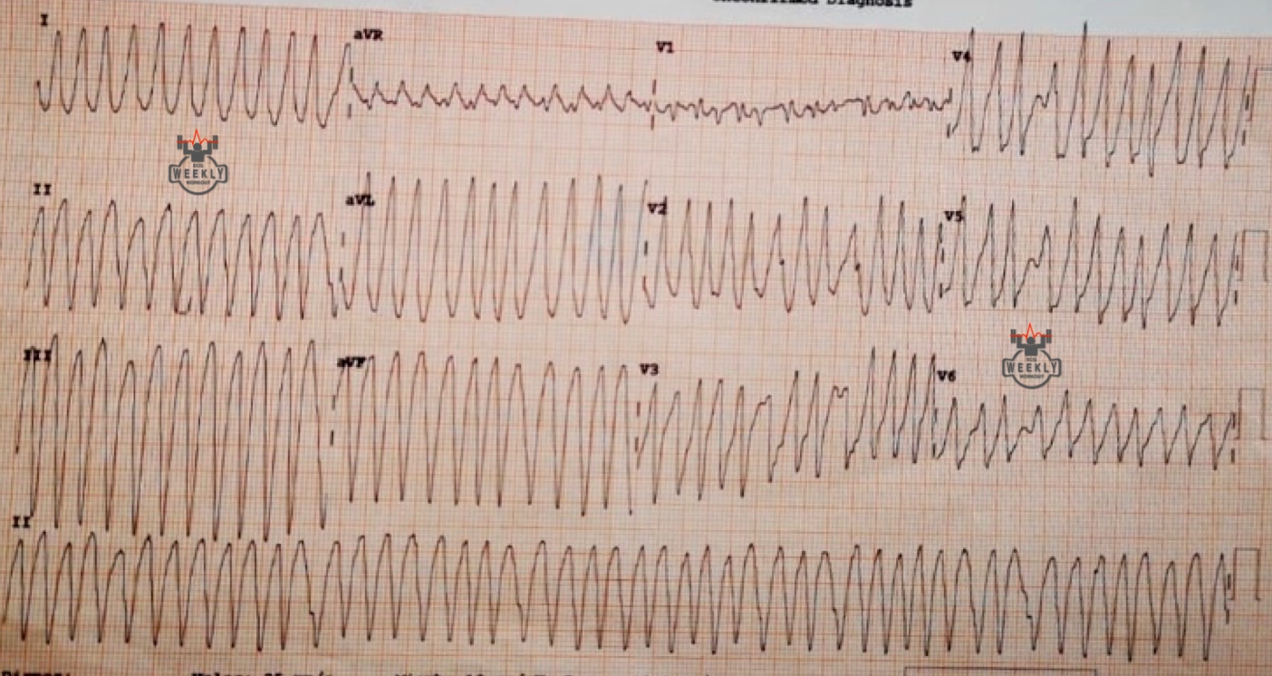Presenting ECG — Wide Complex Tachycardias: when administering the wrong medication can cause a "clean kill"