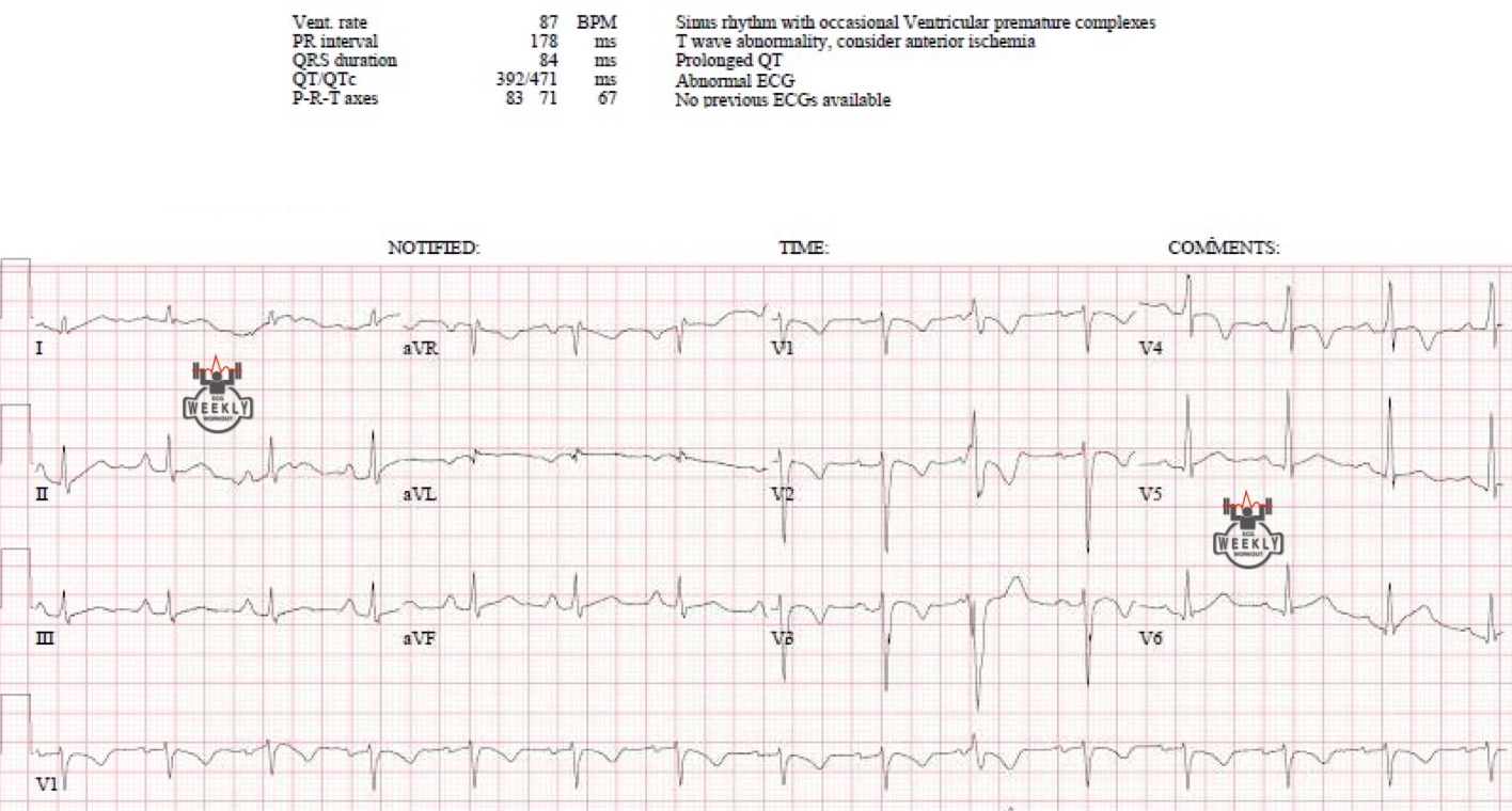 Presenting ECG — Syncope: what to consider when the history and physical exam are not suggestive of an etiology