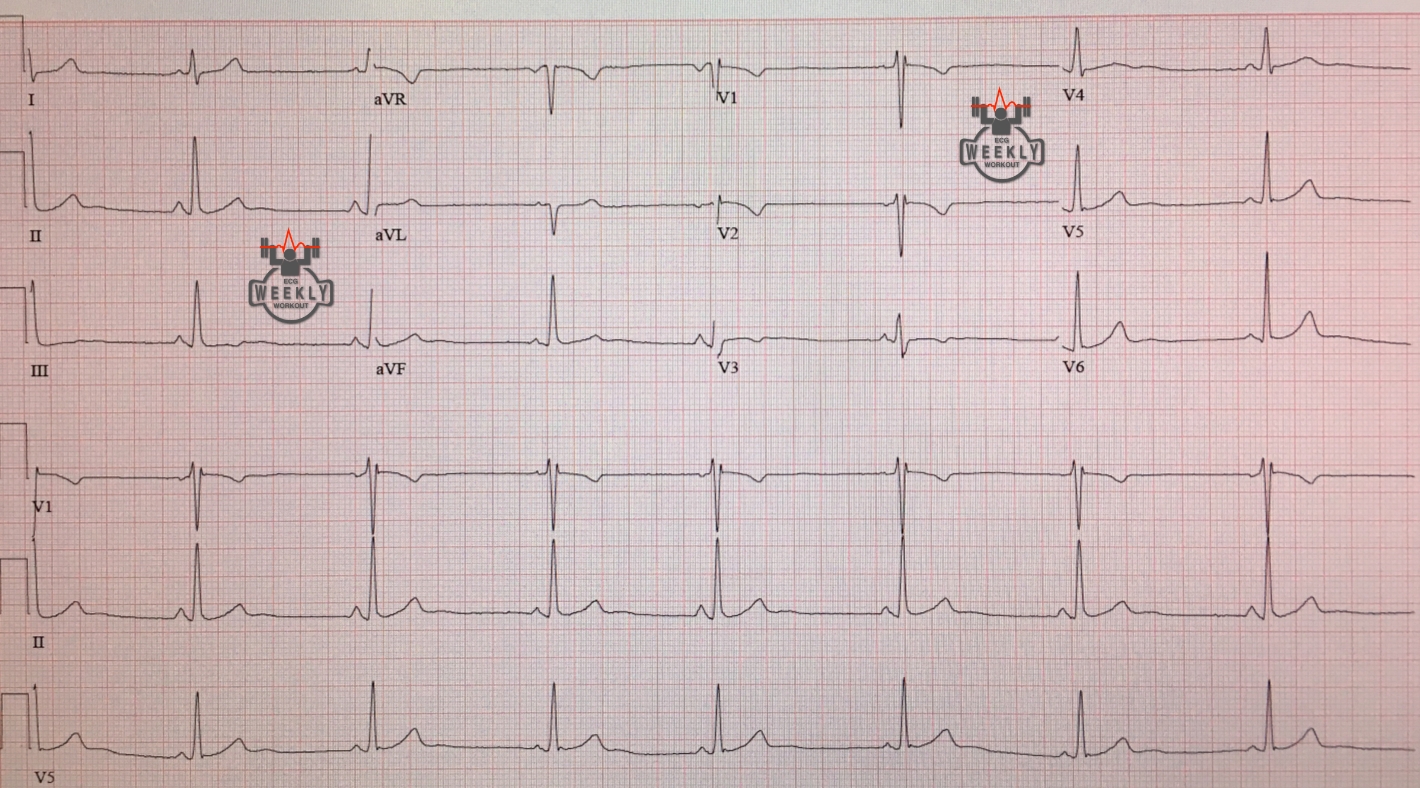 Presenting ECG — Differential Diagnoses: the many causes of T wave inversions