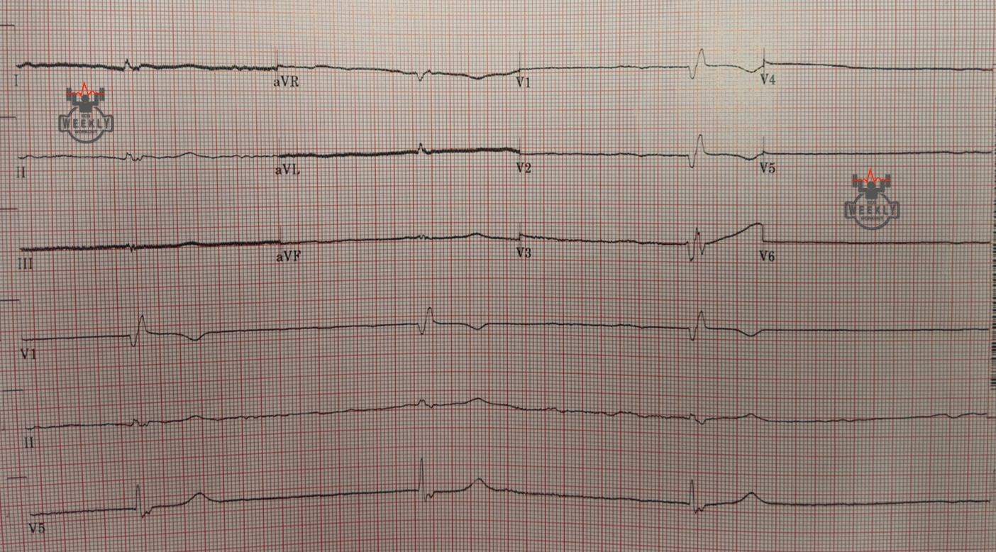 Presenting ECG — ECG Basics & Fundamentals: the ECG findings of hypothermia