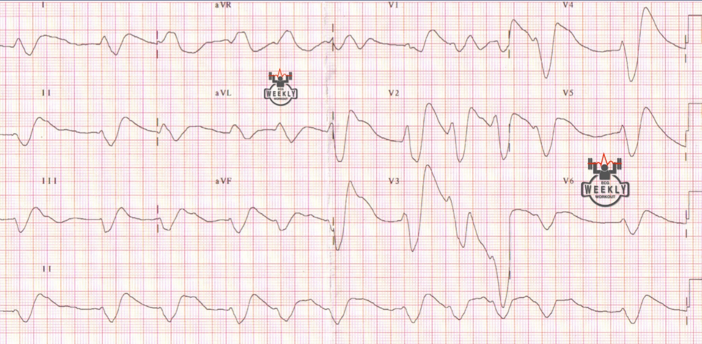 Presenting ECG — STAT ECG Diagnoses: the value of ECGs in acute neurological emergencies