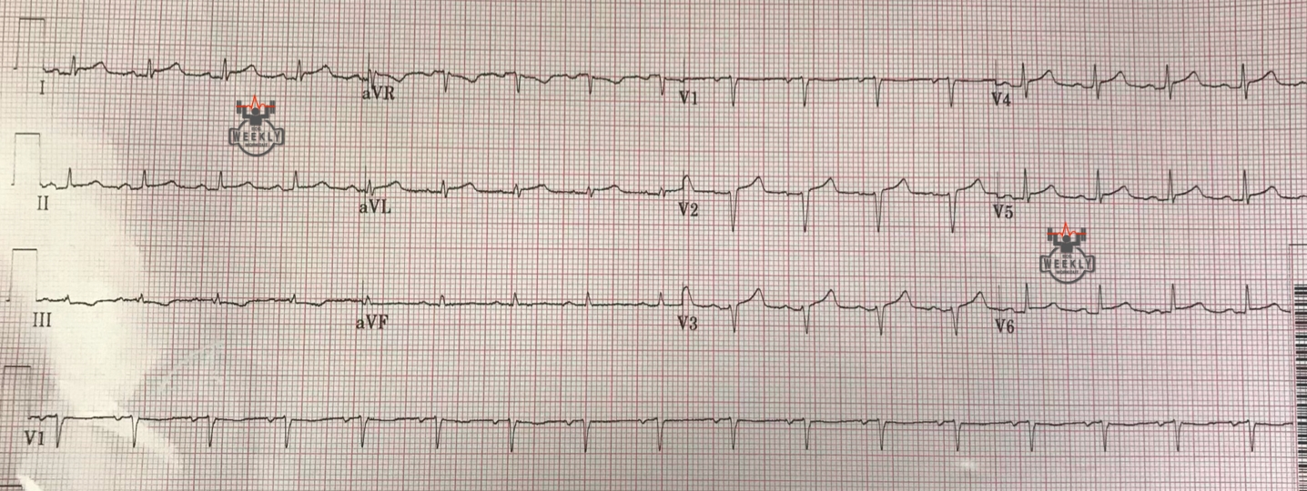 Presenting ECG — ECG Basics & Fundamentals: criteria for low voltage QRS complexes and poor R wave progression