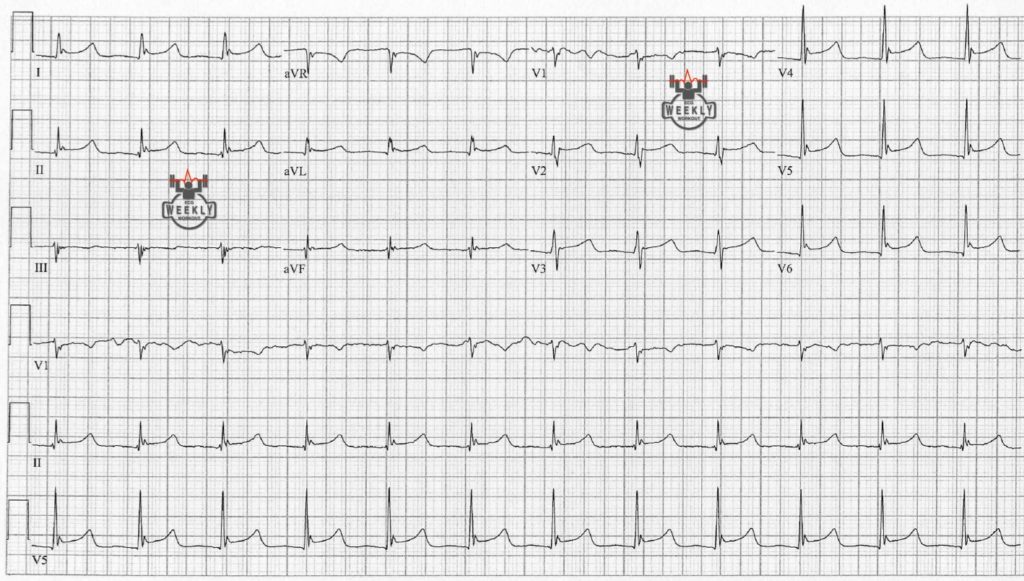 Presenting ECG — Differential Diagnoses: terminal QRS distortion in the differentiation of STEMI from early repolarization